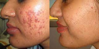 acne treatment Orange CA