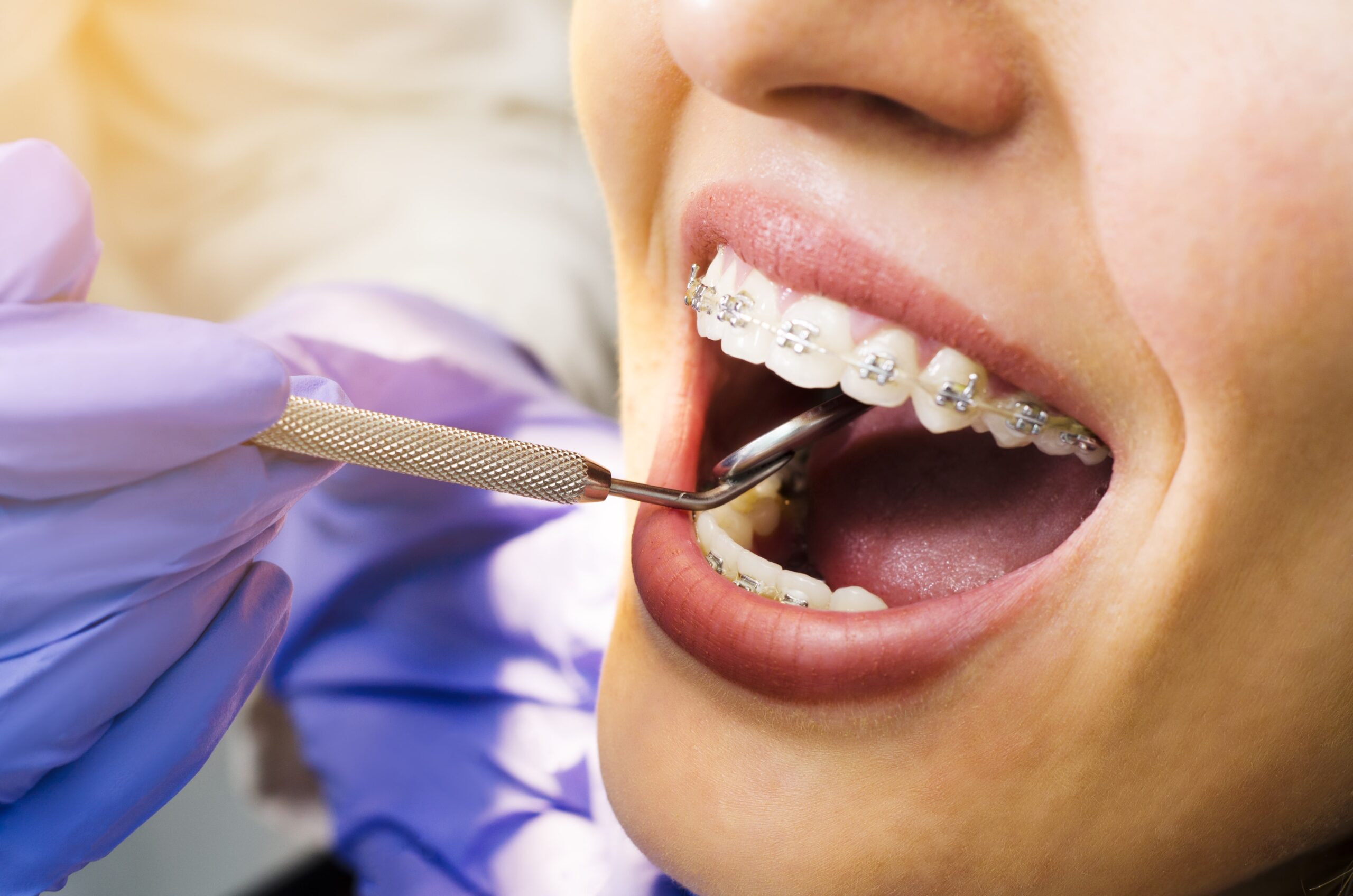 dental braces Westlake Village CA