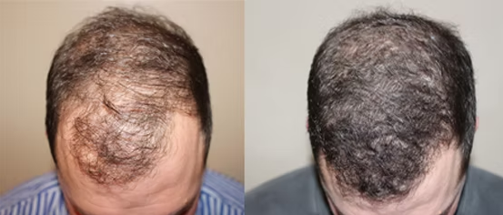 Hair Loss Treatment Center Dr. Jay R. Goldstein, MD: Leading the Way in Restoring Confidence